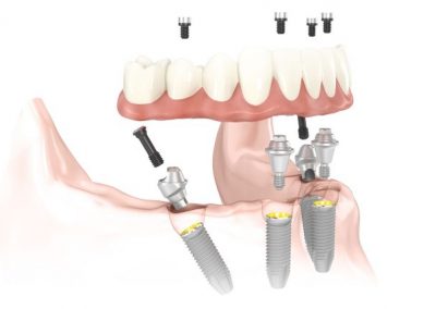 Dentalni implantati